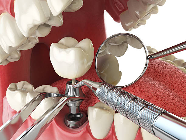 Best Emergency Denture Repair in Atlantic Beach, NC